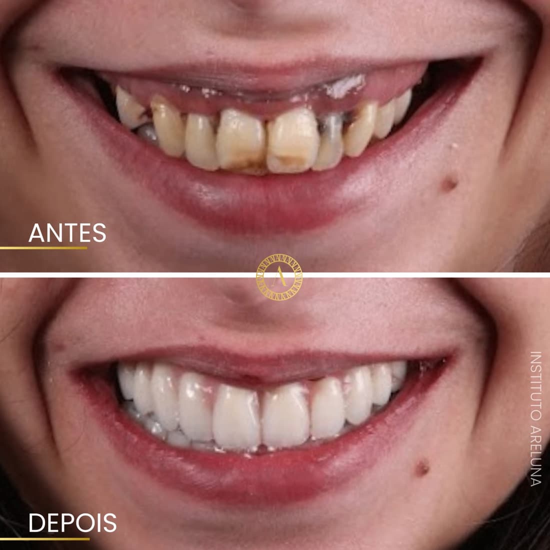 Sorriso renovado — caso real Instituto Areluna